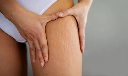 Detalhe de pele com textura suavizada após tratamento de estrias